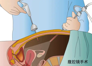 宮腹腔鏡檢查