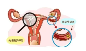 輸卵管堵塞